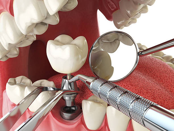 Best Emergency Dentist for Lost Fillings or Crowns in , OH